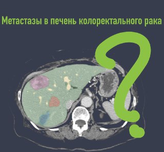 Метастазы колоректального рака в печень не приговор